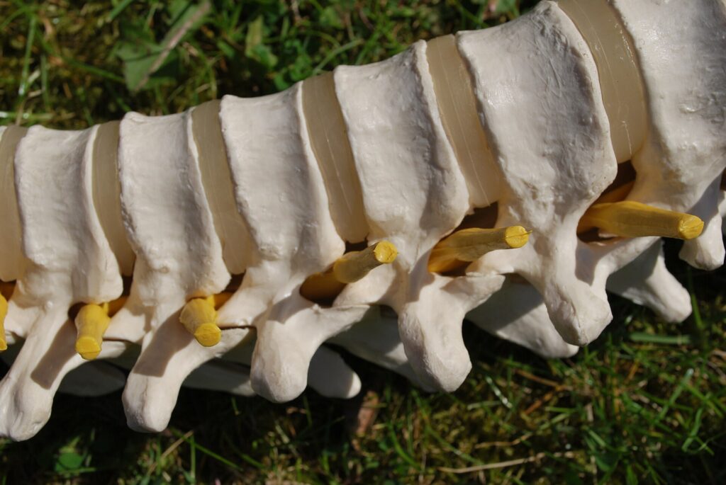 Wirbelsäule mit Neuroforamen – Behandlung der Neuroforamenstenose in Linz